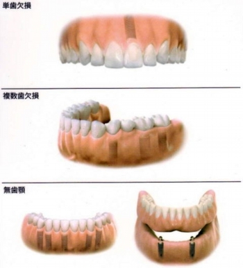 implant-hikaku1.jpg